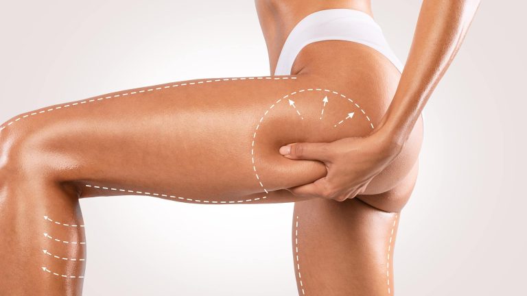 O Papel da Cirurgia Plástica no Tratamento do Lipedema