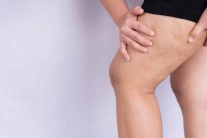 O Papel da Dermatologia no Tratamento do Lipedema
