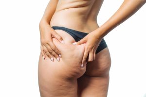 O Papel do Cirurgião Vascular no Tratamento do Lipedema