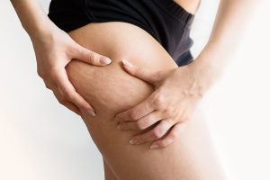 “Dra, como descobrir se eu tenho lipedema?”