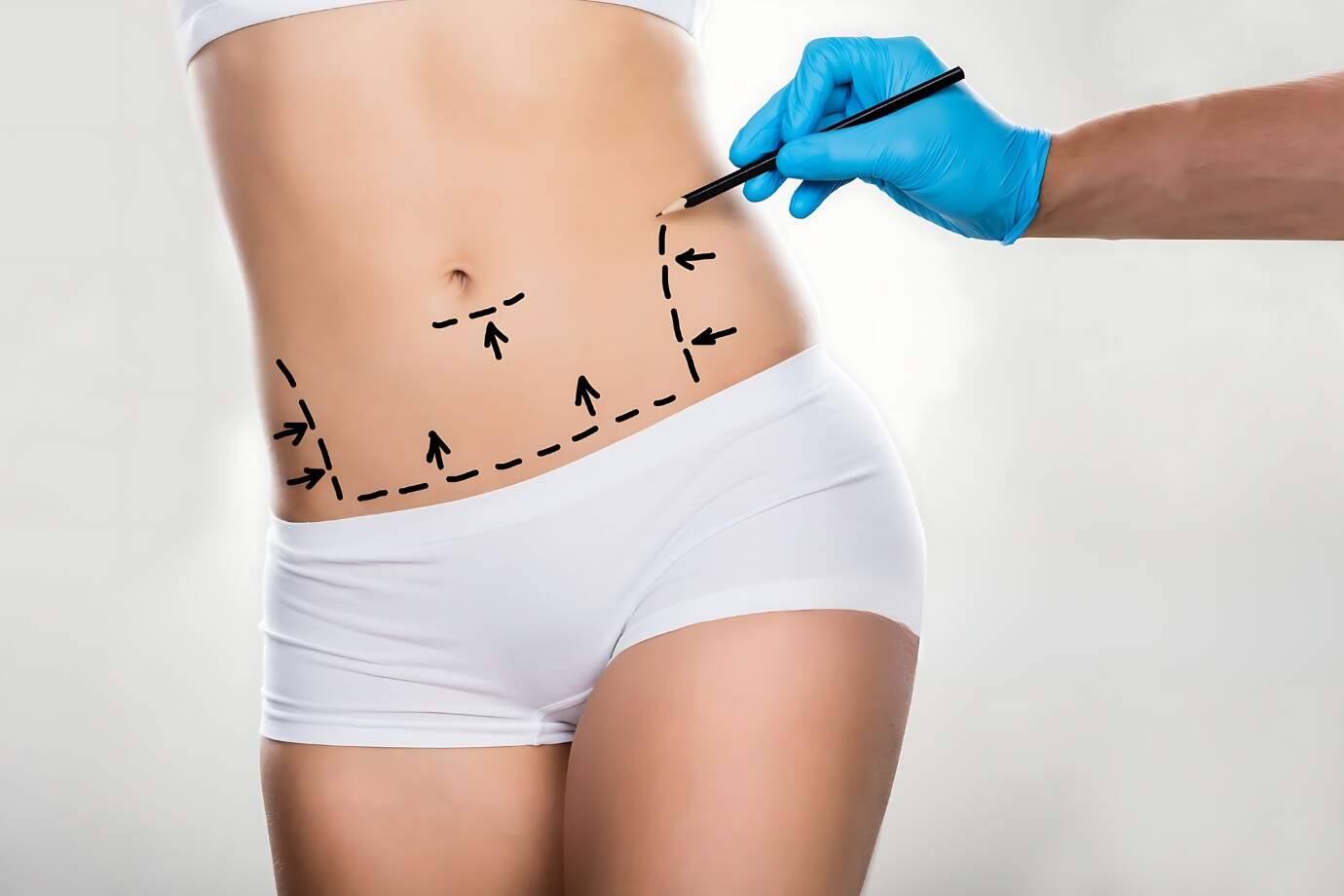 Abdominoplastia