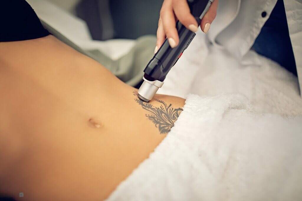 Remoção de Tatuagem a Laser: Tudo o que Você Precisa Saber.