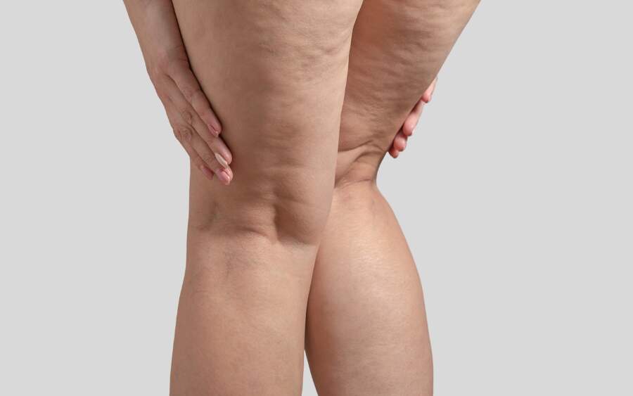 sintomas do lipedema