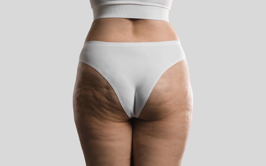 sintomas do lipedema