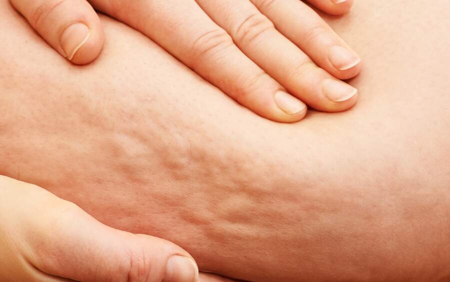 lipedema tratamento