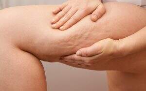 Lipedema Tratamento