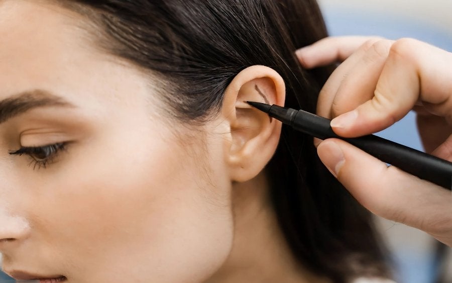 Otoplastia: Recupere sua Autoestima Agora Mesmo!