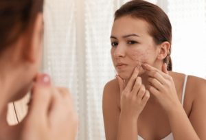 Cicatriz de acne: tipos e tratamentos