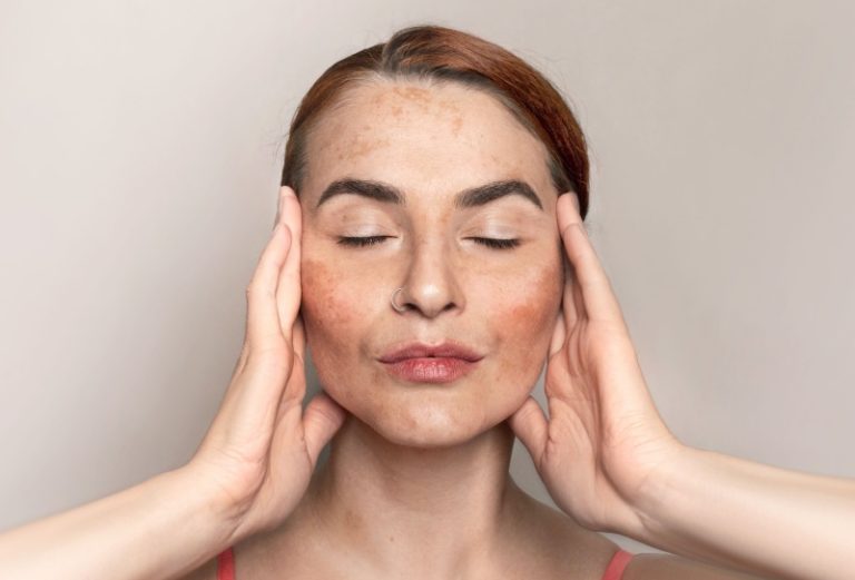 Melasma: o que é, causas, diagnóstico e riscos