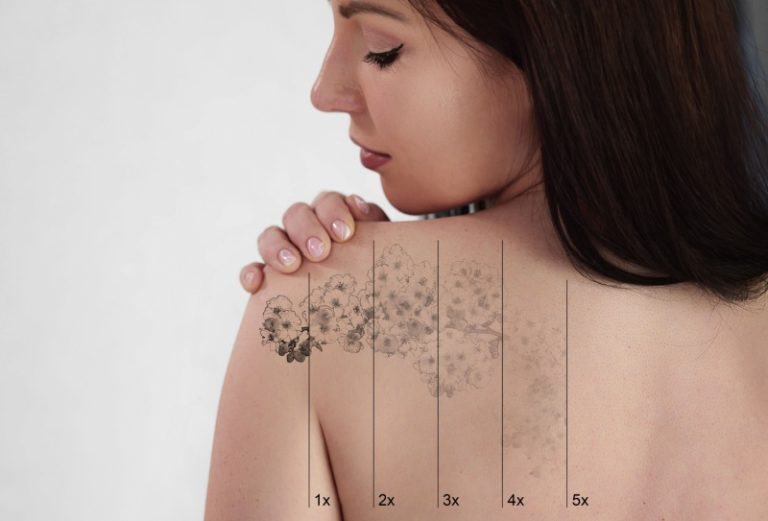 Como remover tatuagem com segurança?