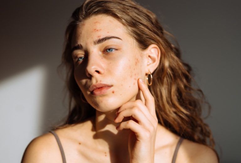 Tratamento para acne: métodos com resultados eficazes