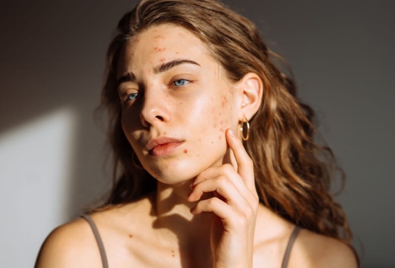 Tratamento para acne: métodos com resultados eficazes