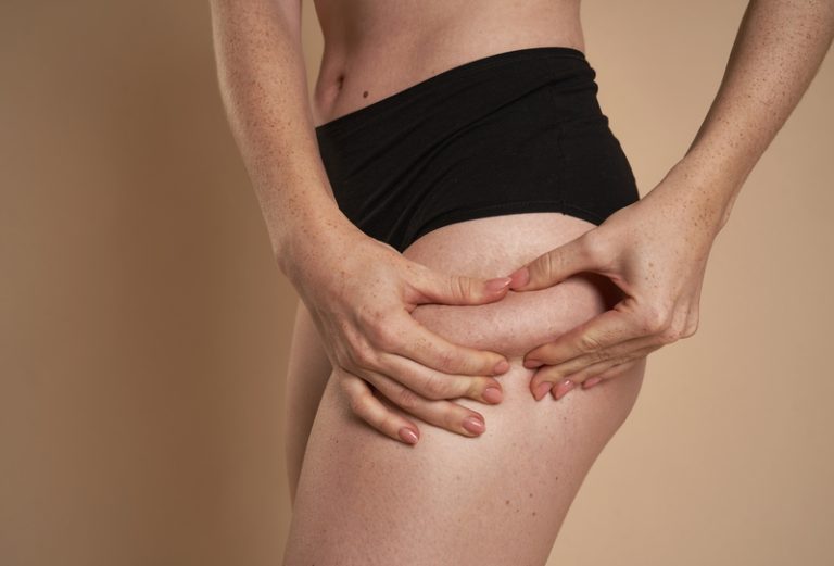 Celulite: o que é, causas e como eliminar