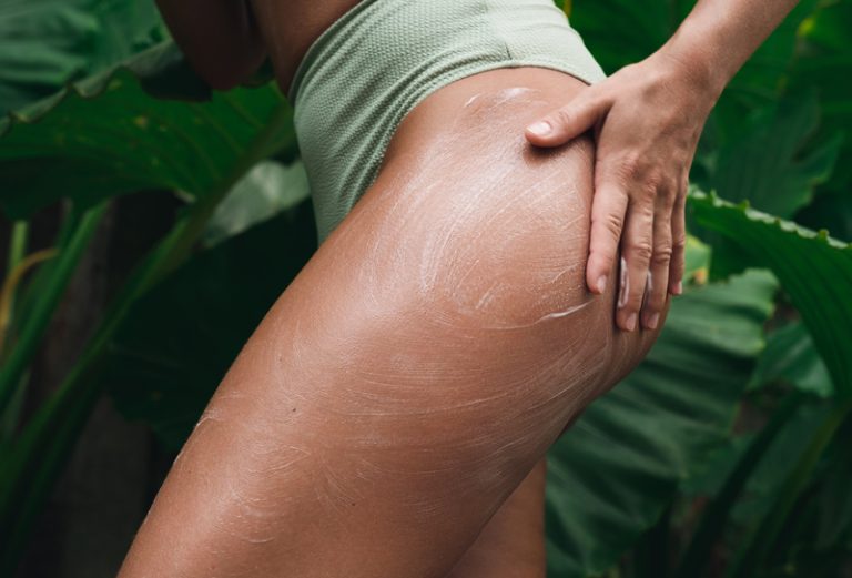 Qual é o melhor tratamento para estrias?