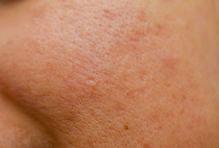 Textura irregular da pele: todas as dicas para uniformizá-la