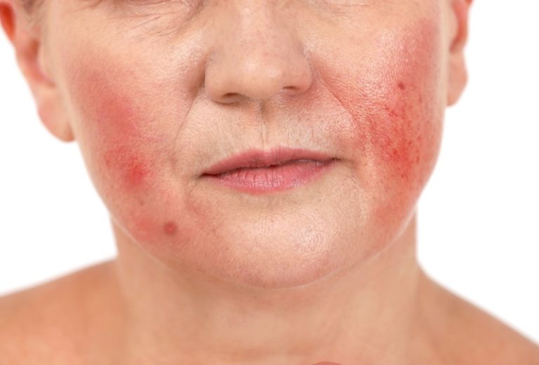 Quais são as opções de tratamento para rosácea?