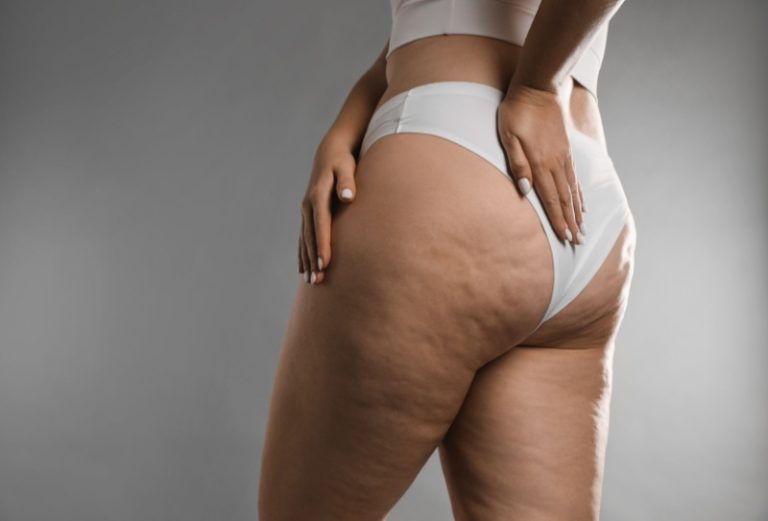 Lipedema: o que é, sintomas e tratamento
